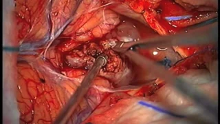 Fourth ventricle tumor