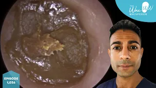 1,036 - Chewing Gum Ear Wax Removal