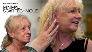 Dr. Engel Facelift _ Cheryl's Experience