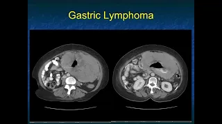 CT of Lymphoma: Involvement of the GI Tract - Part 1