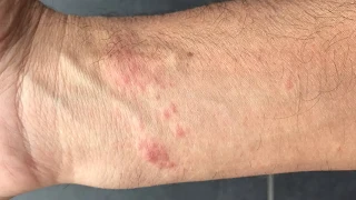 Poison Ivy Treatment with Methylprednisolone