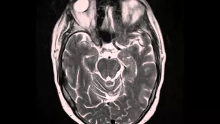 Metastatic Melanoma, with ciliary body globe involvement