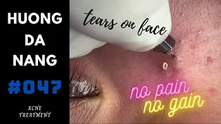 #047 | Squeeze hidden acne and blackheads - tears on face | Before the demand for Social distancing