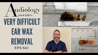 VERY DIFFICULT EAR WAX REMOVAL - EP641