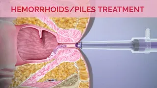 Hemorrhoids Removal Surgery I Hemorrhoid Treatment with Laser Surgery & Rubber Band Ligation