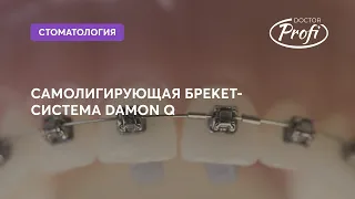 О БРЕКЕТАХ DAMON