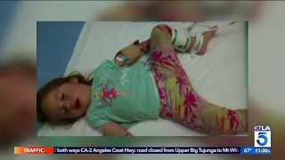 Hesperia Girl Recovering from Snake Bite