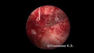 Эндоскопическая полисинусотомия. Полипозный риносинусит. Endoscopic sinus surgery. Nasal polyposis.
