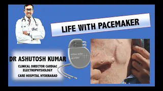 Life after pacemaker implantation-