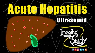 Acute Hepatitis || Ultrasound Lecture || Imaging Study