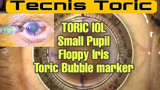 #157 Toric IOL in a small pupil | Toric Bubble Marker | Axis Marking technique @DrPrateekJain_eye