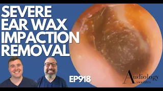 SEVERE EAR WAX IMPACTION REMOVAL - EP918