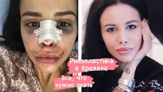 Я сделала нос 💫 Ринопластика и септопластика в Ереване и все что нужно о ней знать