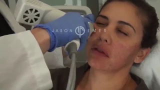 Syneron Profound Microneedling with Radiofrequency / Skin Facial Tightening and Lifting