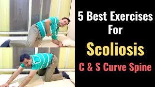 5 Best Exercises for Scoliosis, How to Correct Scoliosis, Stretches for Scoliosis, Spinal Curvature