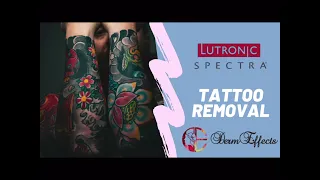 Spectra Laser Tattoo Removal