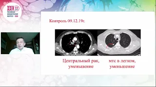 Предиктивные биомаркеры эффективности ингибиторов PD-1/PD-L1