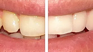 Whiten Yellow Teeth in 2 Minutes | Photoshop