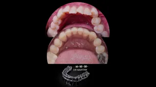 علاج باستخدام التقويم الشفاف. عرض حالات قبل و بعد. Clear aligners treatment. Before and After.