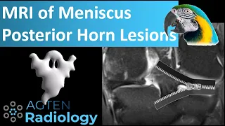 7 Meniscus Posterior Horn Lesions on MRI