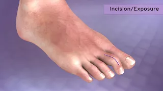 HammerTube Hammertoe System