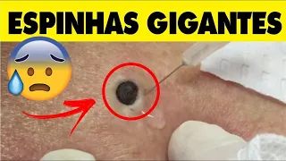 6 - Pimple Popping Compilation Most Popular Sebaceous Cyst Amazing Abscess On Nose of Poor little
