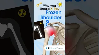 X-Ray Frozen Shoulder? #physicaltherapy #physiotheraphy #frozenshoulder #shoulderpain