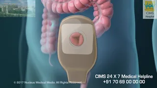 Treatments for Colorectal Cancer (Hindi) – CIMS Hospital