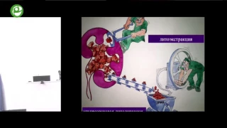 Дутов С В - Перкутанная нефроскопия и удаление камней. Осложнения ПНЛ