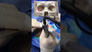 Scarless orbital decompression technique