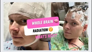 After whole brain 🧠 radiation ☢️