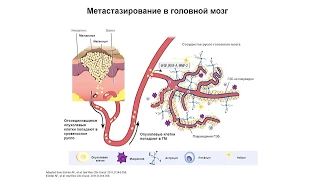 Метастатическое поражение головного мозга при меланоме. Как выбрать правильный алгоритм лечения?