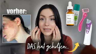 Der ultimative  SKINCARE Guide (Tipps gegen Pickel)