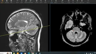 27 year old with extremity weakness and numbness