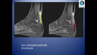 Ankle MRI Part 4: Achilles and Plantar Fascia