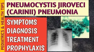 Pneumocystis Jiroveci Pneumonia (P. Carinii) Symptoms, Radiology, Treatment & Prophylaxis