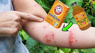 Escape the POISON IVY ITCH: Natural Home Remedies for Poison Ivy Rash