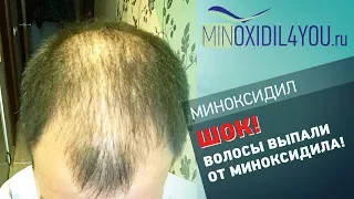 Миноксидил для волос. Шок! Выпали волосы после миноксидила. Миноксидил откат. Minoxidil4you