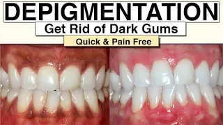 Black Gums (How To Get Rid Of Them With Gum Depigmentation)