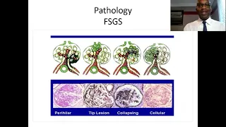 Newly Diagnosed Adult Session – Learning the Basics of Glomerular Disease from Lab Values to Diet