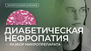 Диабетическая нефропатия | Патологическая анатомия