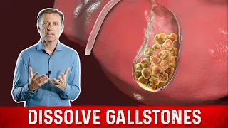 What Causes Gallstones & How to Treat Them – Dr.Berg