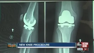 New knee procedure keeps healthy ligaments