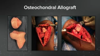 T3 AMZ System with Fresh Osteochondral Allograft | Dr. Brian Cole