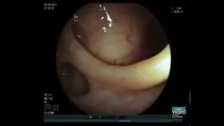 Colonic Diverticulosis