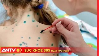 Bệnh thủy đậu: Nguyên nhân, triệu chứng, và cách điều trị | Sức khỏe 365 | ANTV