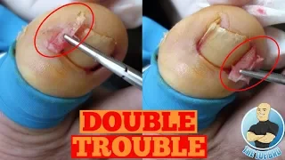 DOUBLE INGROWN TOENAIL REMOVAL FOREVER-Toe Nail Surgery by The Toe Bro