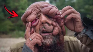 10 Real Unbelievable People With Genetic Mutations