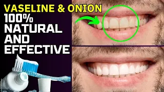 3-Minute Home Teeth Whitening: 100% Natural and Effective!