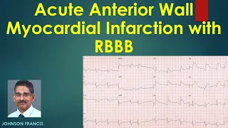 Acute Anterior Wall Myocardial Infarction with RBBB